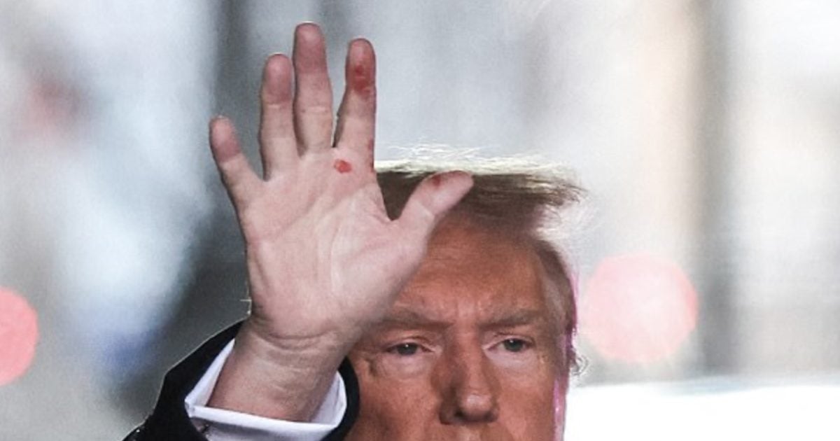 What Are The Red Marks On Trump’s Hands?